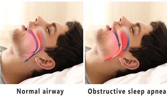 Side by side drawings of airways with normal versus obstructed breathing