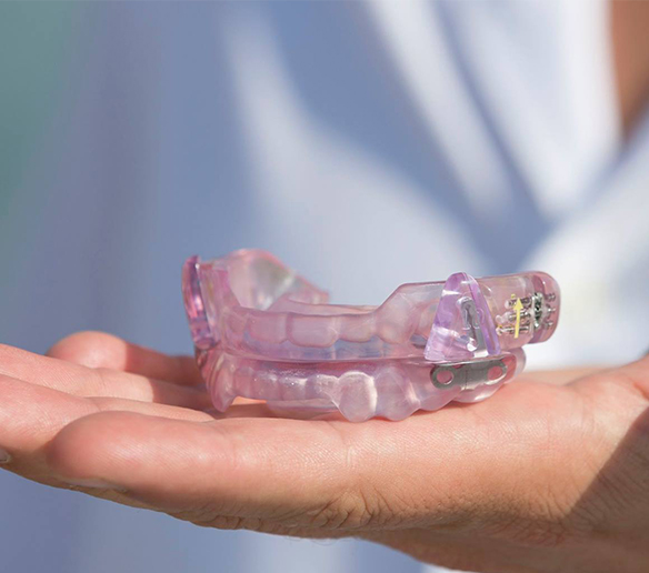 Hand holding light purple SomnoMed oral appliance